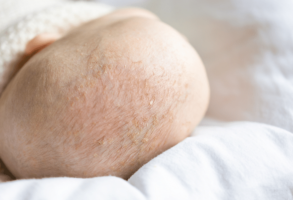 croûtes de lait sur le cuir chevelu d’un bébé