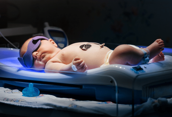 bébé sous lampe bleue pour traiter un ictère néo-natal