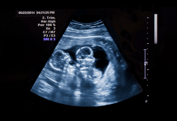 Echographie d'une femme enceinte qui découvre qu’elle attend des jumeaux,
