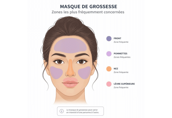 Schéma des zones du visage fréquemment touchées par le masque de grossesse