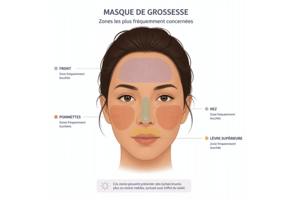 Illustration de la répartition des taches de mélasma sur le visage