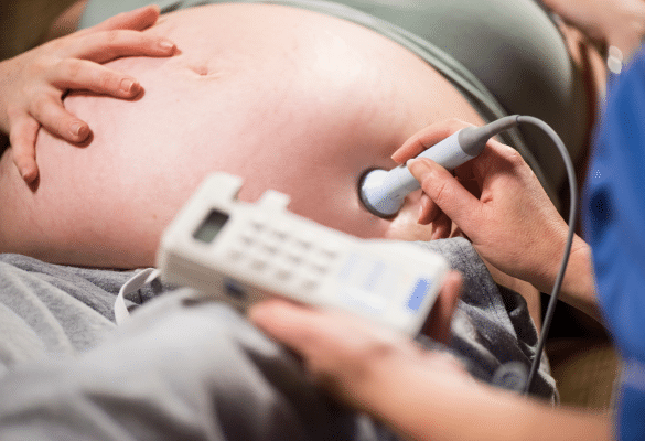 monitoring rythme cardiaque bebe declenchement accouchement