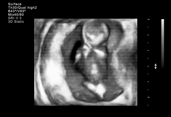 Image d’échographie illustrant la position du fœtus en présentation du siège dans l’utérus.