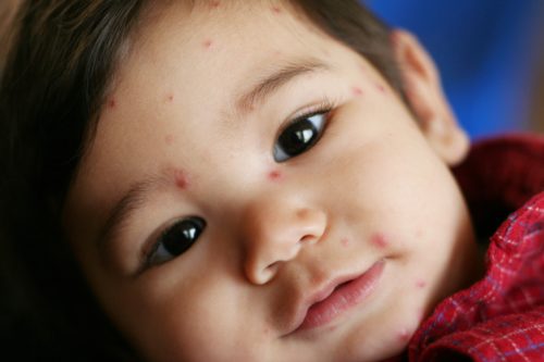 Maladies infantiles : rougeole, varicelle et oreillons