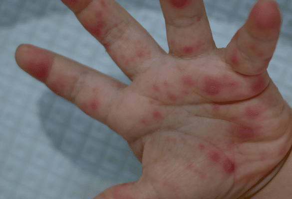 lésions cutanées main enfant pied main bouche vésicules cutanées