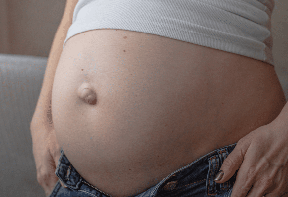 Hernie ombilicale chez une femme enceinte avec bosse visible au niveau du nombril