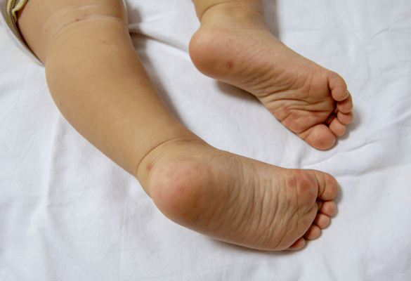 lésions cutanées pieds bébé pied main bouche éruption cutanée