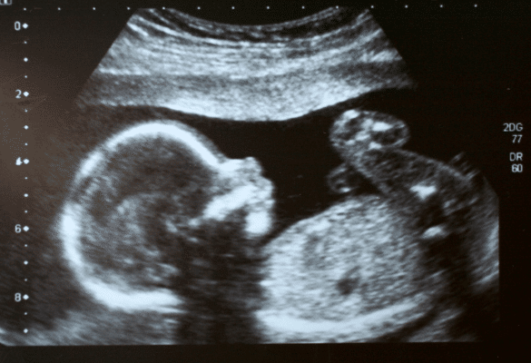 image échographique montrant un fœtus dans le ventre de sa mère. Le sexe de bébé est visible de manière fiable lors de l’échographie morphologique.
