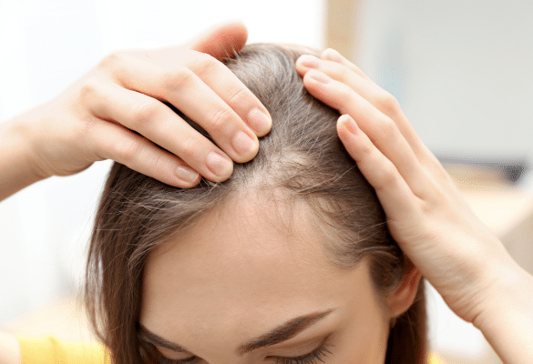 Jeune femme observant son cuir chevelu et écartant ses cheveux pour constater une chute localisée après l’accouchement, symbole d’alopécie post-partum