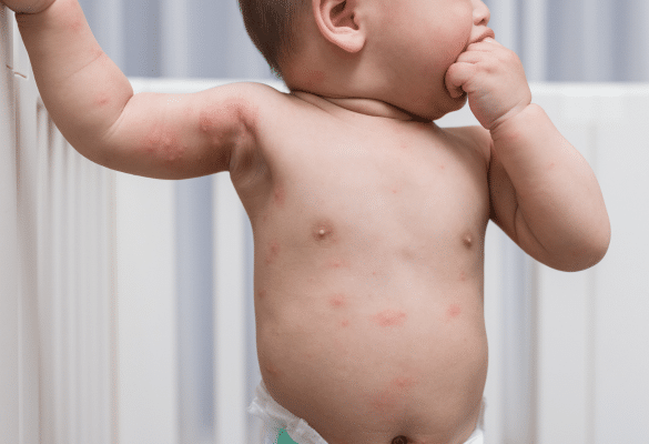 éruption cutanée enfant varicelle boutons peau maladies infantiles